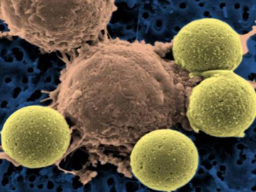 An engineered CAR T cell (center) binding to beads, which cause the T cell to divide. In CAR T cell therapy, the engineered T cells are expanded into the hundreds of millions and then infused back into the patient. Credit: National Institutes of Health, CC BY-NC-SA 2.0